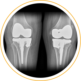 Complex Total Knee Replacement