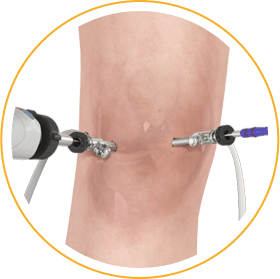 Knee Arthroscopy