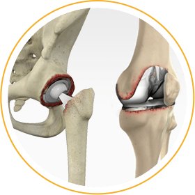 Robotic Total and Partial Knee Replacement