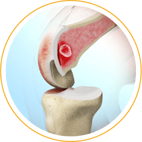 Robotic Total and Partial Knee Replacement