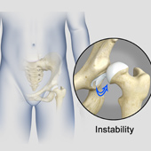 Hip Instability