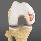 Articular Cartilage Injury