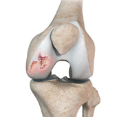 Chondral or Articular Cartilage Defects