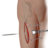 Complex Hip Reconstruction Surgery