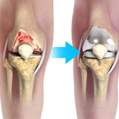 Complex Total Knee Replacement