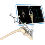 Computer Navigation for Total Knee Replacement