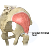 Gluteus Tendon Tear