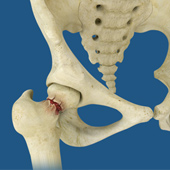 Hip Fracture Surgery