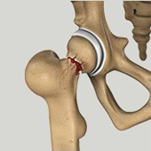 Hip Injuries