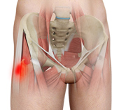 Hip Tendonitis