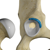 Hip Trauma Reconstruction