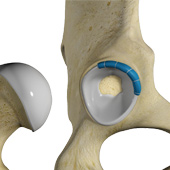 Hip Trauma Reconstruction