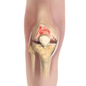 Knee Osteoarthritis