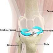 Medial Meniscus Syndrome