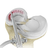 Meniscal Surgery