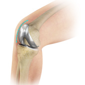 Minimally Invasive Knee Joint Replacement