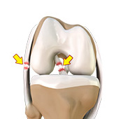 Multiligament Knee Injuries