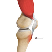 Osgood Schlatter Disease