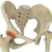 Osteoarthritis of the Hip