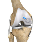 Osteochondritis Dissecans of the Knee