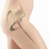 Outpatient Anterior Approach Hip Replacement