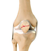 Fractures of the Patella