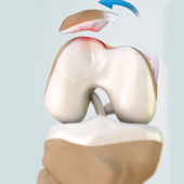 Patellar Dislocation or Patellofemoral Dislocation