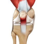 Patellar Tendinitis