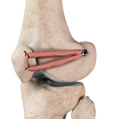 Patellofemoral Knee Replacement