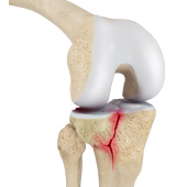 Tibial Plateau Fracture