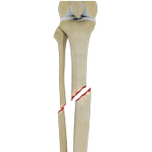 Tibial Shaft Fracture