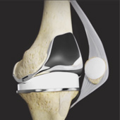 Tricompartmental Knee Replacement